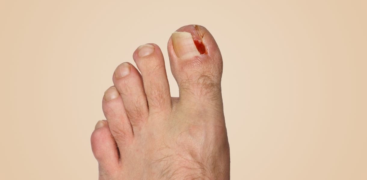 nail surgery in Sohna