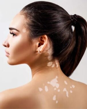 vitiligo treatment gurgaon