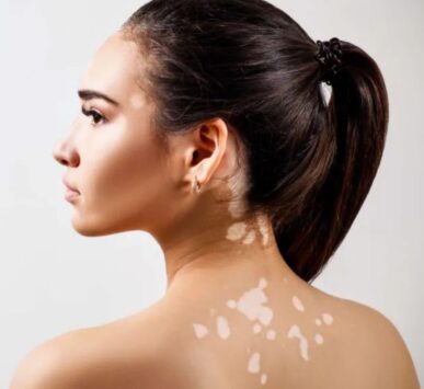 vitiligo treatment gurgaon