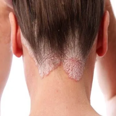 psoriasis-neck