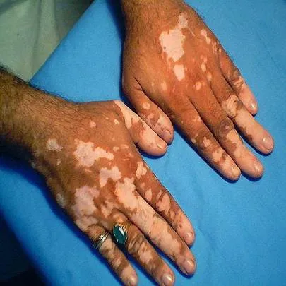 vitiligo