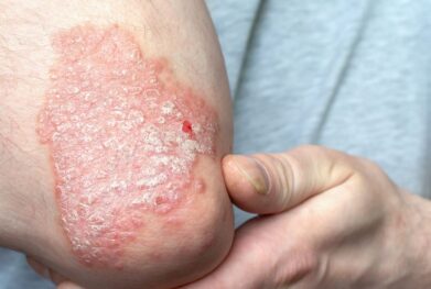 Psoriasis Management