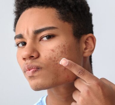 acne treatment gurgaon