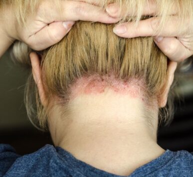 psoriasis treatment gurgaon