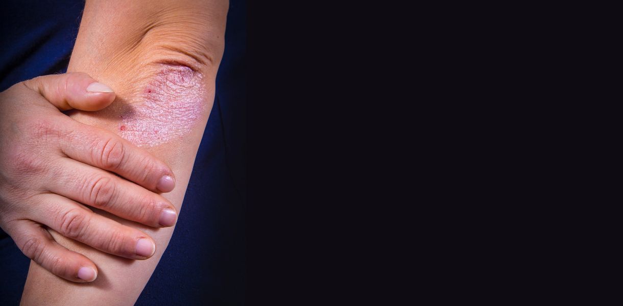 psoriasis treatment Gurgaon