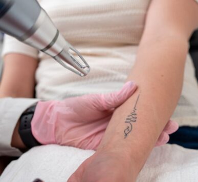 tattoo removal gurgaon