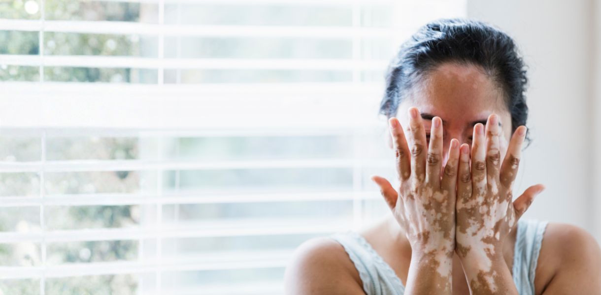 vitiligo treatment gurgaon