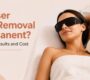 laser hair removal 90x80