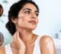 Vitiligo Symptoms 90x80